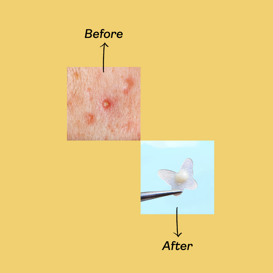 Yukazan Acne Healing Patch 30's | Cute Design Acne Patch | Pimple Acne Patch | Concealer Pimple Patch | Tea Tree Oil